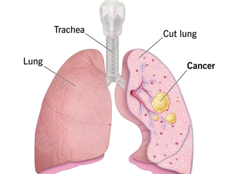 Lung Cancer Issues | Dr Dorai Ramanathan