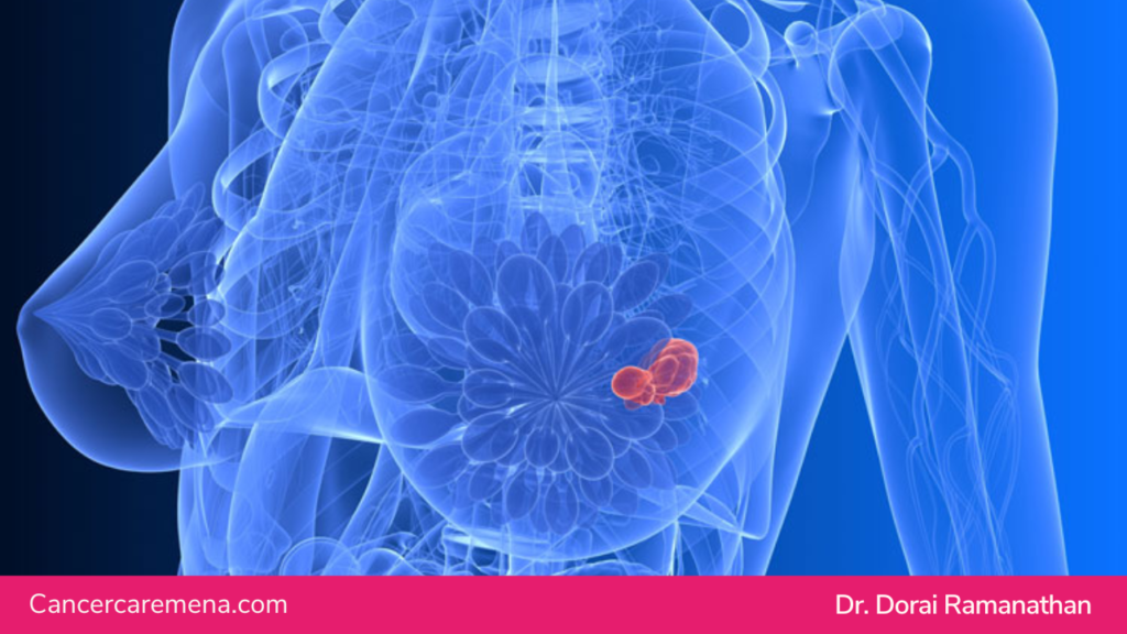 Breast Cancer Spots | Dr Dorai Ramanathan